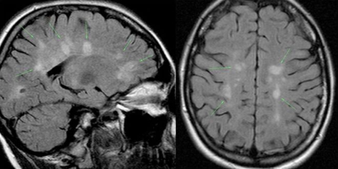 Снимок мозга на МРТ с участками рассеянного склероза