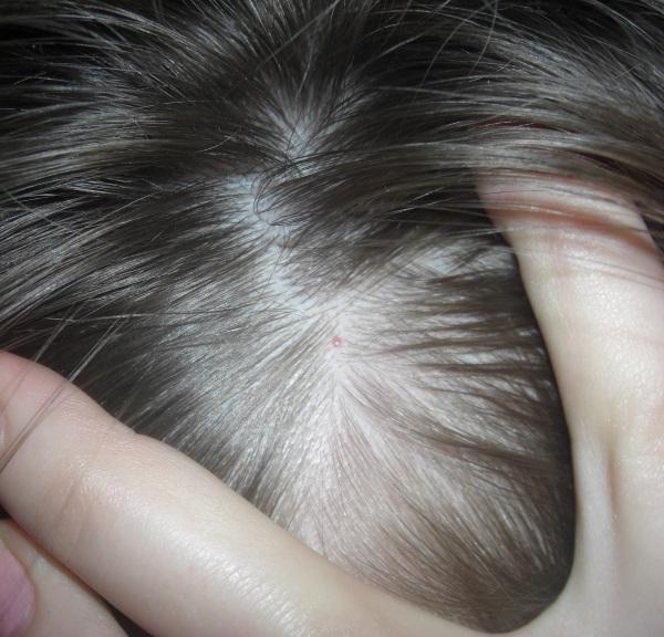 Бородавка на голове в волосах. Эффективные методы лечения