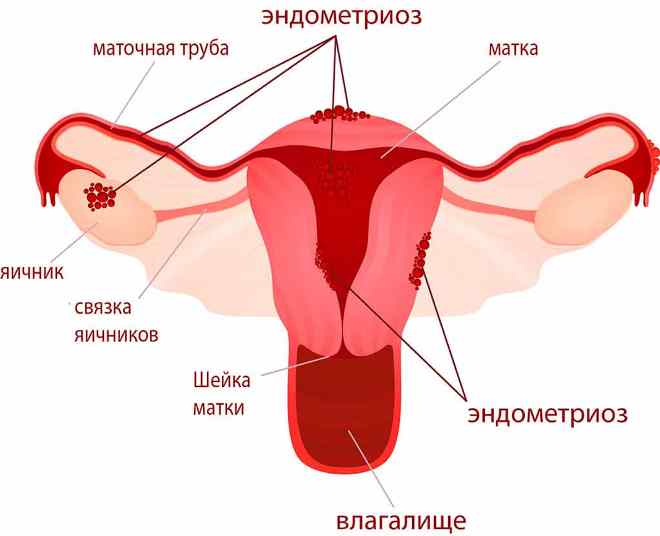 Где располагаются очаги эндометриоза