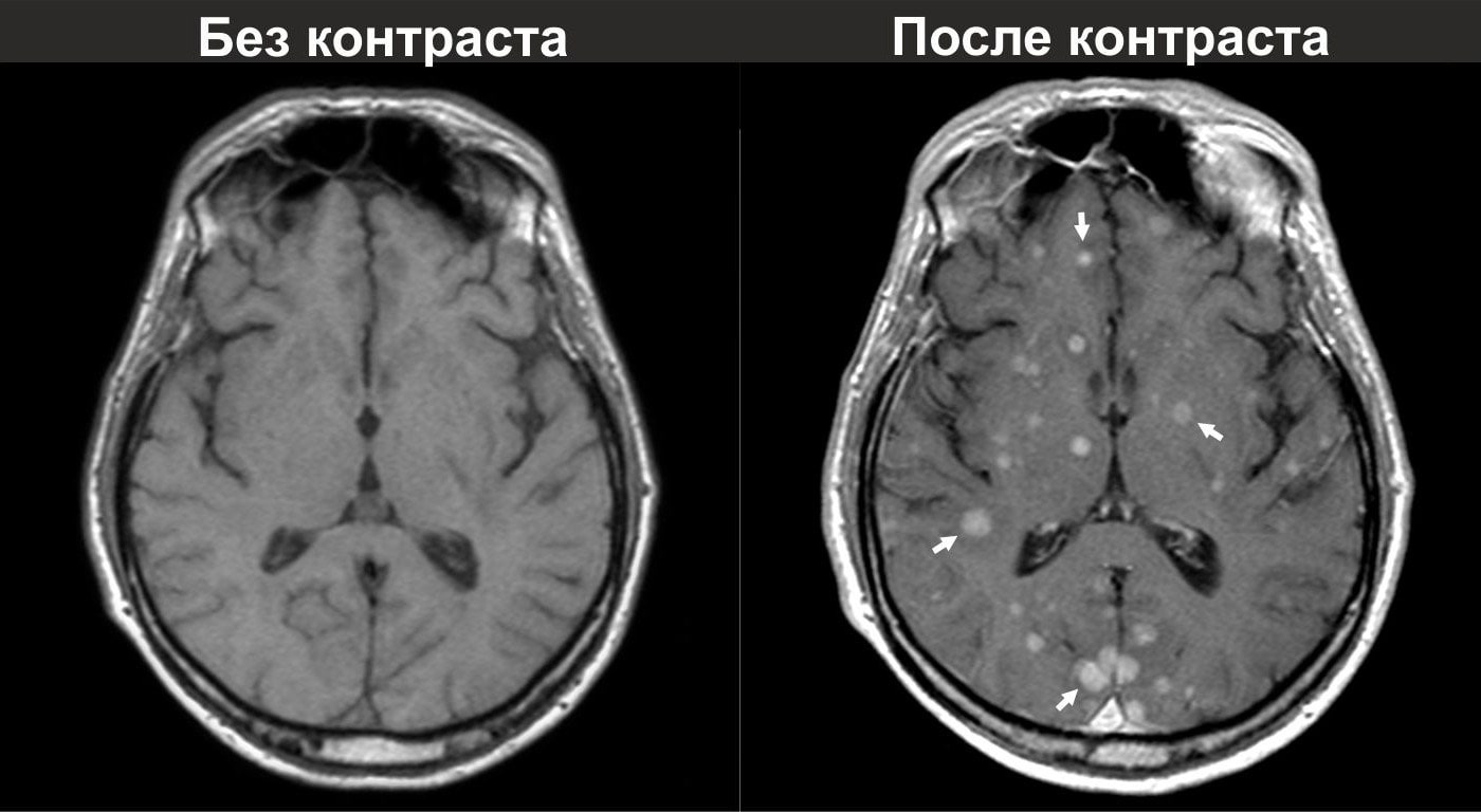 МРТ головного мозга с контрастированием
