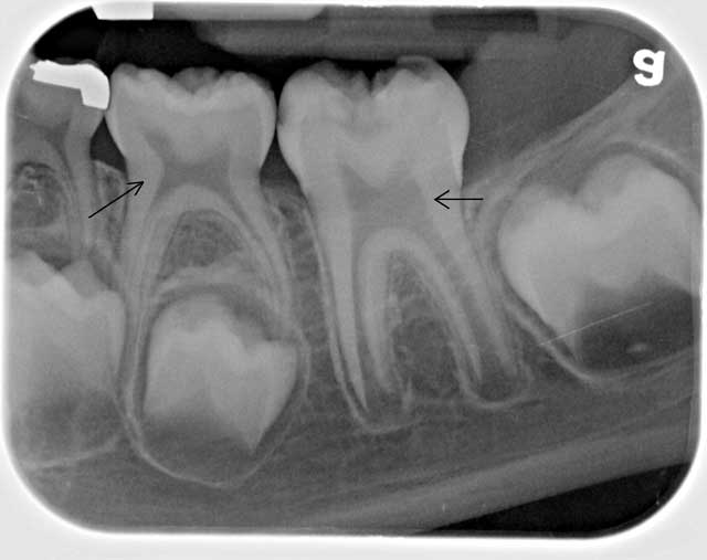 Снимок зубов ребенка 5 лет thumbnail