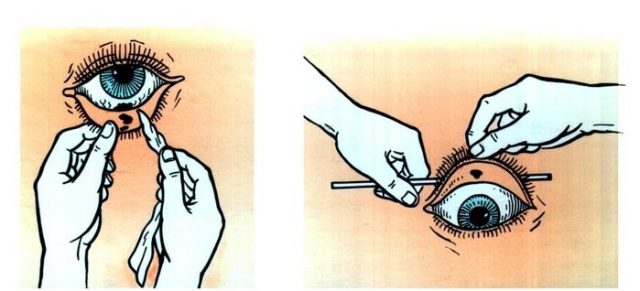 Схема, как вытащить инородное тело из глаза 