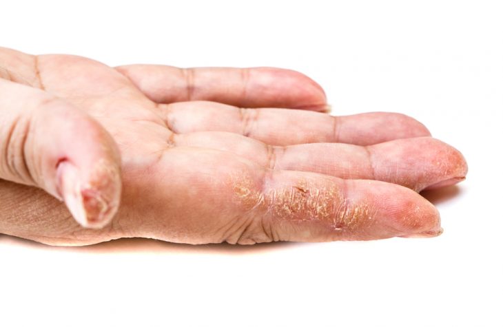 Почему трескается кожа на руках и сохнет и что делать, если она сухая?