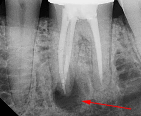 Киста на корне зуба: фото, симптомы и лечение