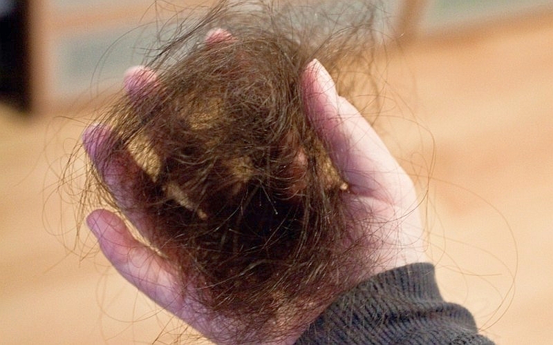 гормоны влияющие на выпадение волос при гормональном сбое