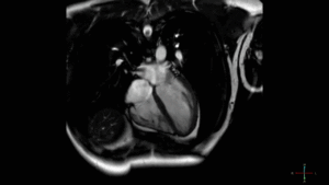 Что покажет МРТ сердца и сосудов