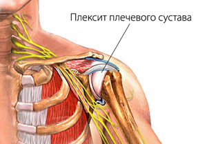 Какие заболевания показывает МРТ плечевого сустава: подготовка, ход диагностики