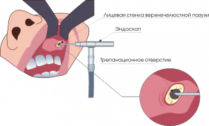 Схема введения троакара и эндоскопа