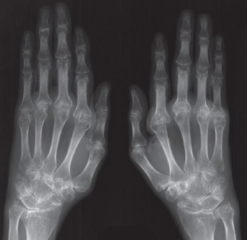 Ревматоидный артрит на рентгене
