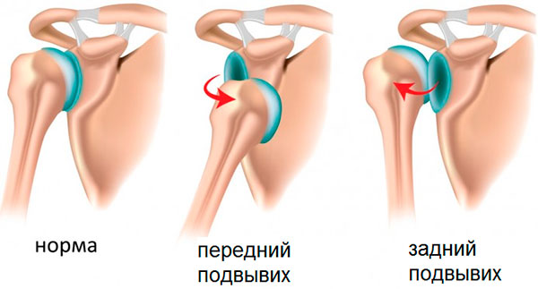 Патологии плечевого сустава: снимок
