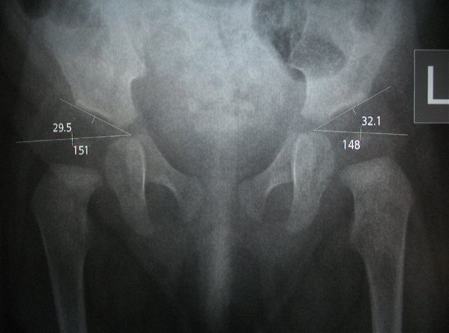 Рентгенография тазобедренного сустава: для чего проводится