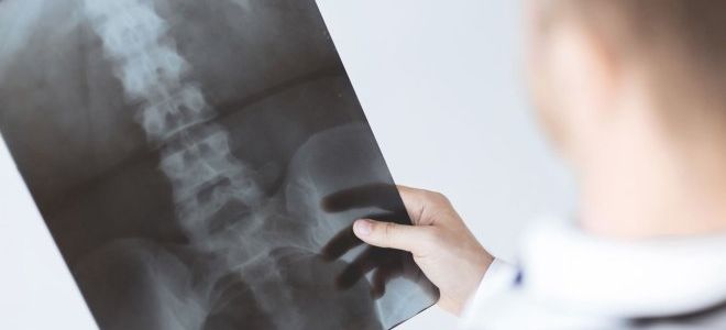 Методы диагностики: рентген или МРТ позвоночника
