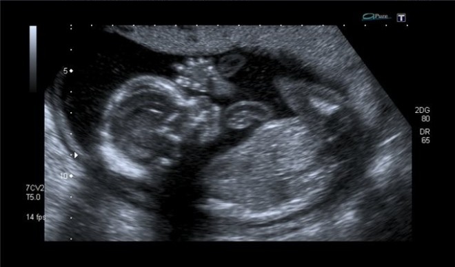 Снимок УЗИ 19 недель беременности
