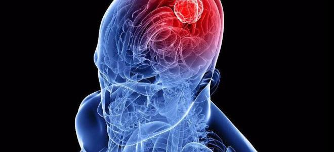 Преимущества и особенности МРТ головного мозга при опухоли мозга