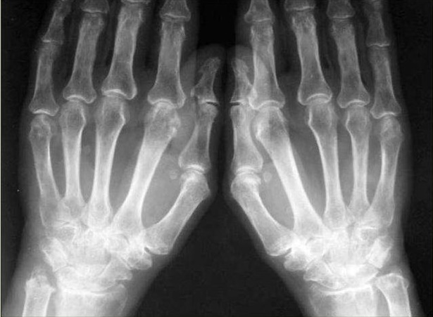 Ревматоидный артрит на рентгене