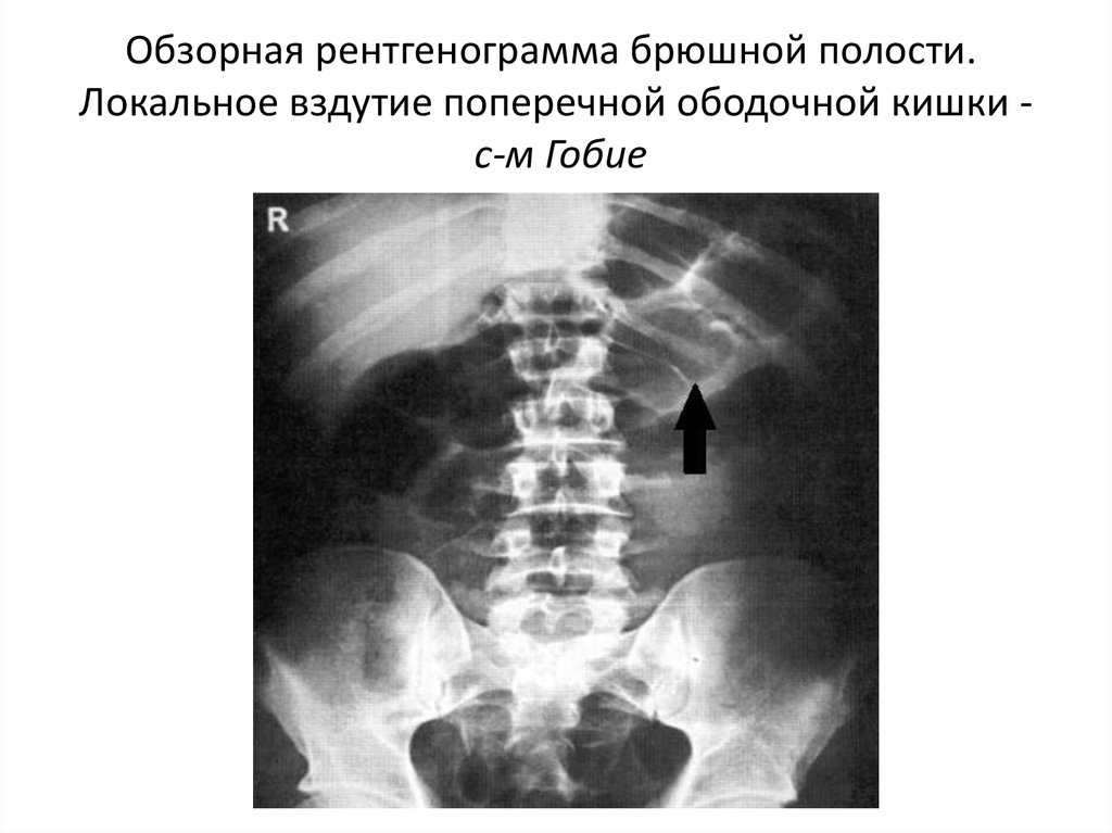 Что можно увидеть на рентгене брюшной полости