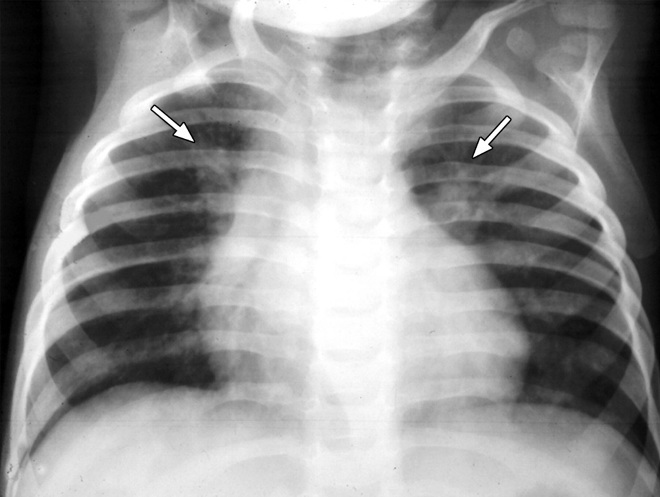 Пневмония на рентгеновском снимке