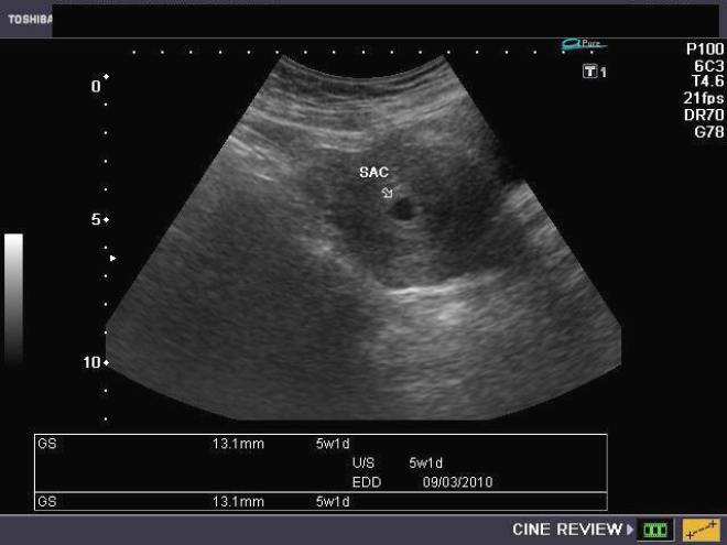 Снимок ЗИ на 3 неделе беременности