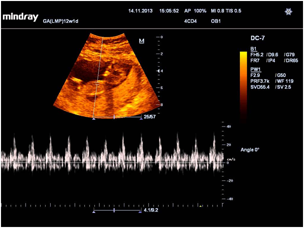 Снимок УЗИ сердца плода