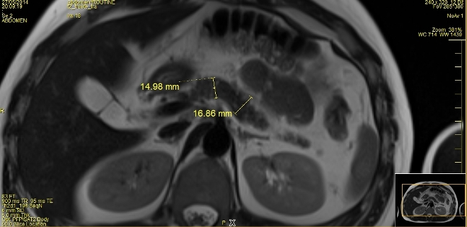 Измерение размеров поджелудочной железы на МРТ