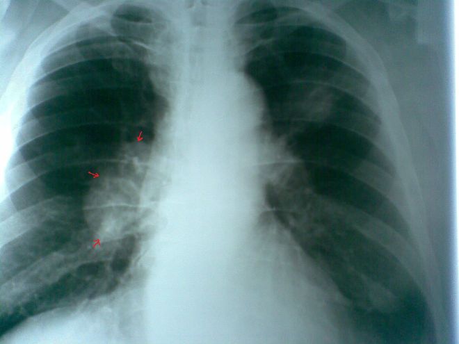 Рак легких на рентгеновском снимке