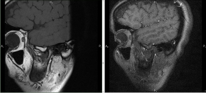 Снимок МРТ височно-нижнечелюстных суставов