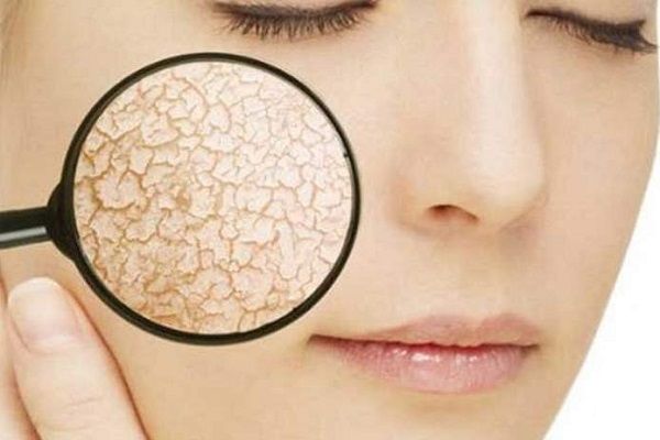 как избавиться от шелушения на лице что делать если кожа сухая
