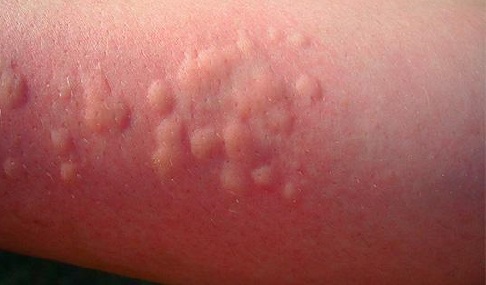Аллергическая крапивница: причины, симптомы и лечение в домашних условиях