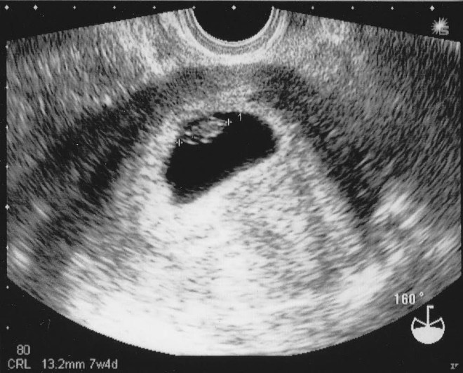 Снимок УЗИ на 7 неделе беременности