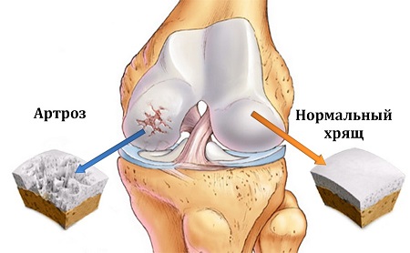 Артроз коленного сустава что это такое и как лечить?