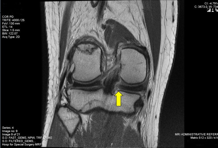 МРТ колена: подготовка и что покажет диагностика