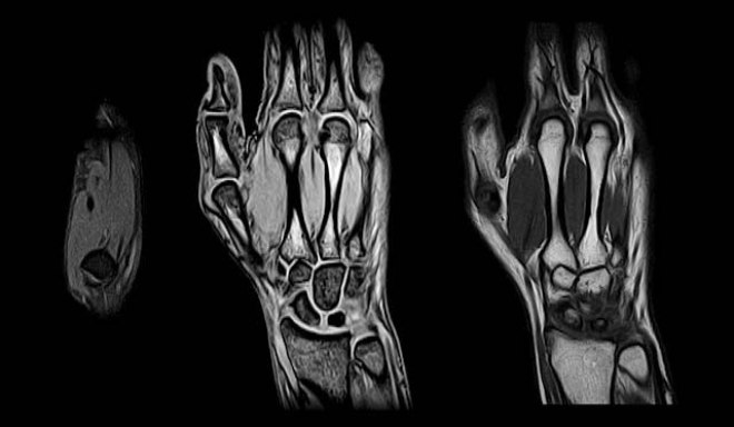 Снимок МРТ кисти руки