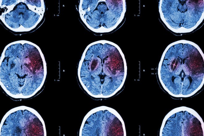 Снимок МРТ мозга с контрастом