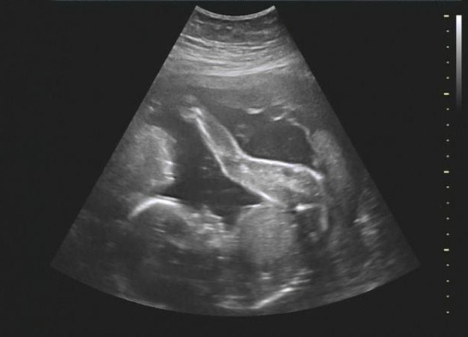 Снимок УЗИ плода на 25 неделе беременности