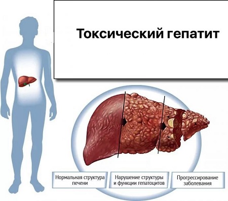 Токсический гепатит печени симптомы и лечение