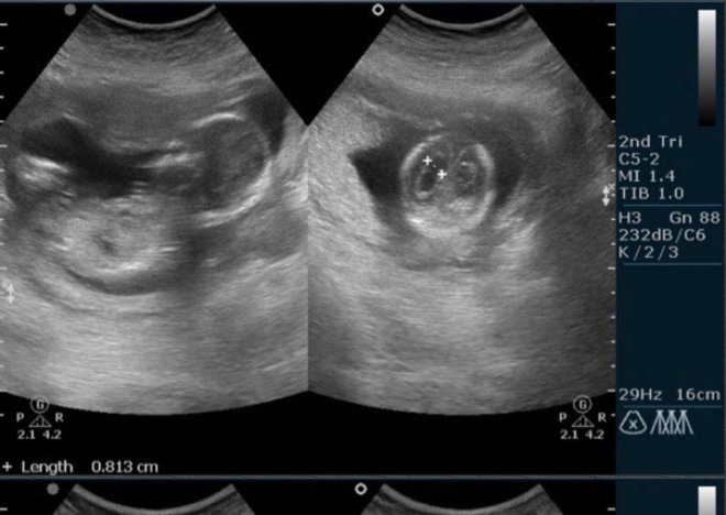 Снимок УЗИ на 17 неделе беременности