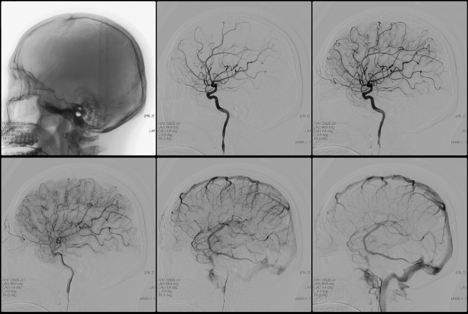 Снимок KT-ангиографии сосудов головного мозга