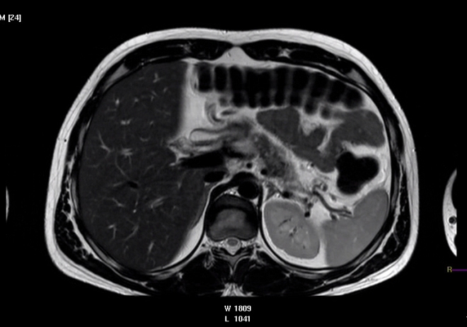 Снимок МРТ брюшной полости