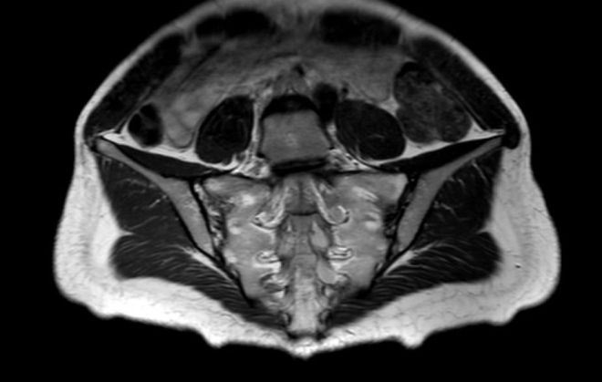 Снимок МРТ крестцово-подвздошных сочленений