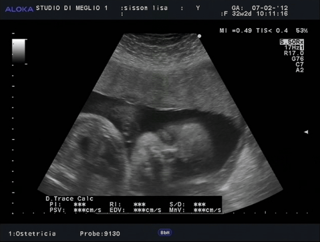 Снимок УЗИ на 31 неделе беременности