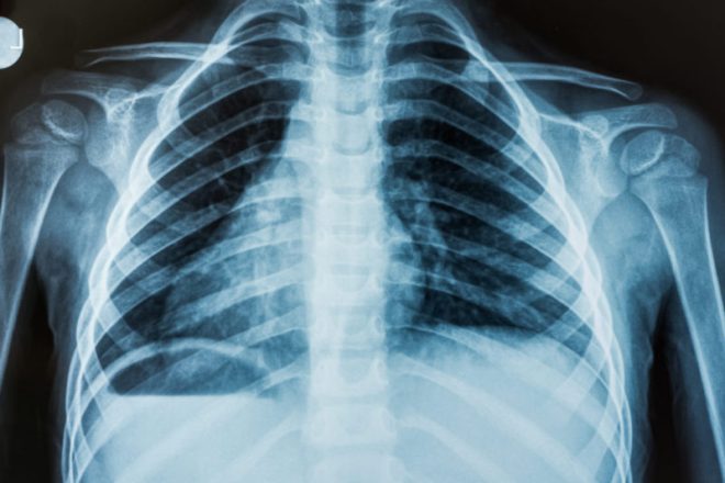 Рентген грудной клетки фото как делают