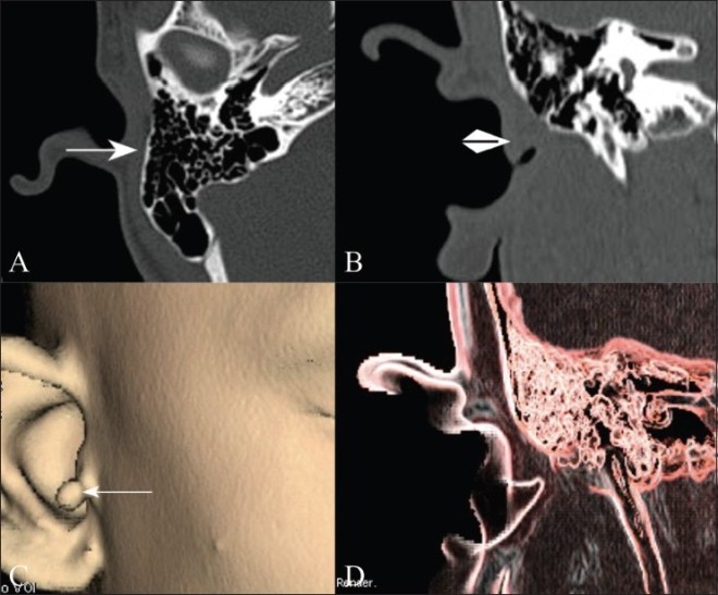 Снимок МРТ уха с контрастом