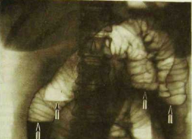 Рентгенография органов брюшной полости с контрастом