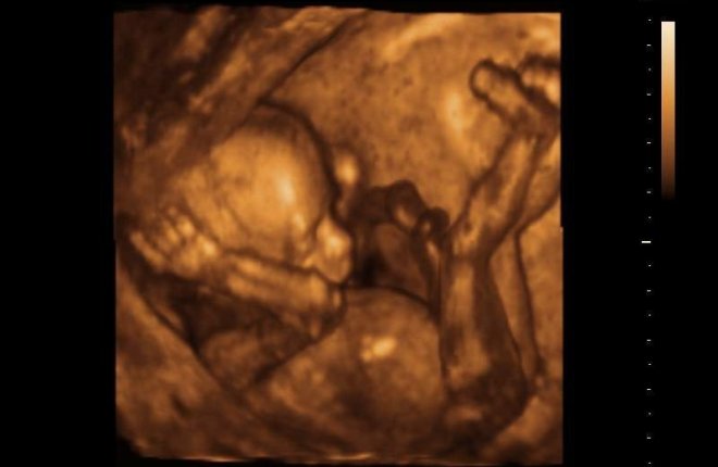 Снимок ребенка на трехмерном УЗИ