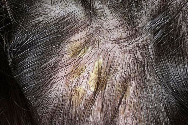 Жирная себорея кожи головы: фото