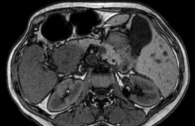 Снимок МРТ поджелудочной железы