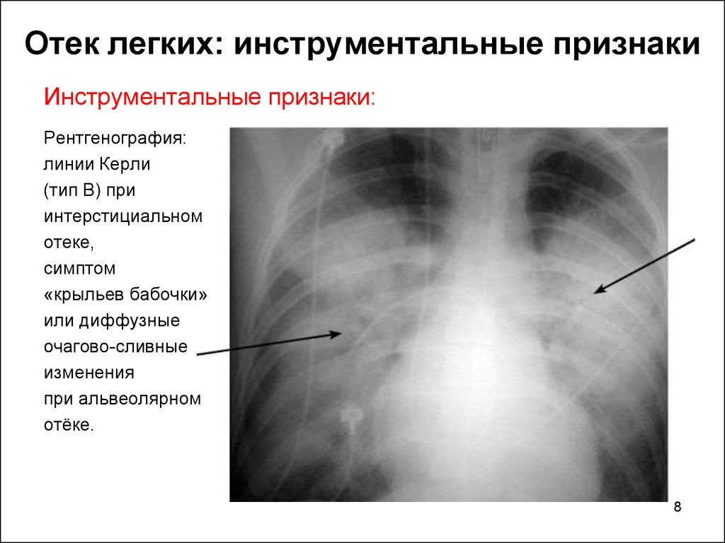 Отёк лёгких: рентгенологические признаки патологии