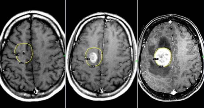 Рак головного мозга на снимке МРТ