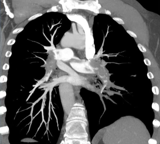 Снимок КТ грудной аорты и легочной артерии