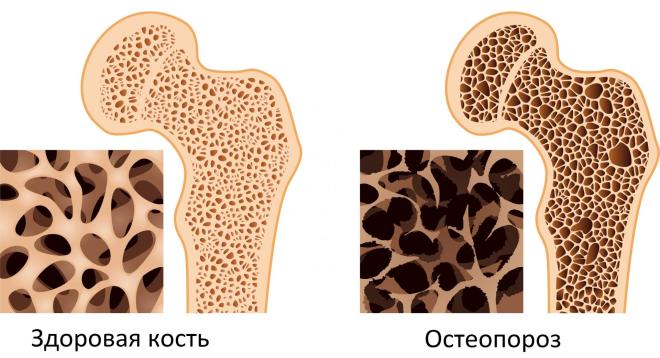 Признаки остеопороза